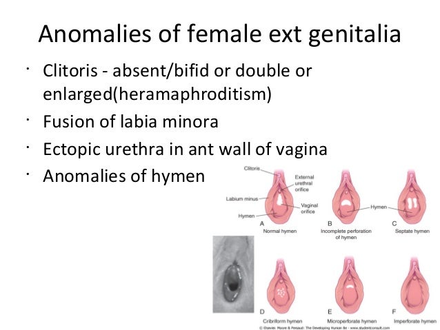 Phimosis of the clitoris pics 374